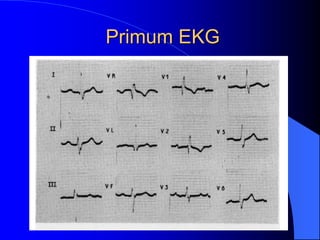 Primum EKG
 