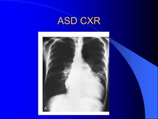 ASD CXR
 