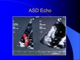 ASD Echo
 