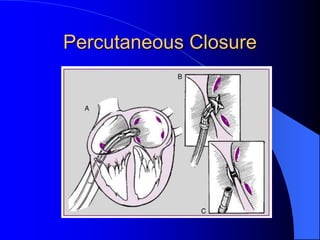 Percutaneous Closure
 