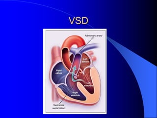 VSD
 