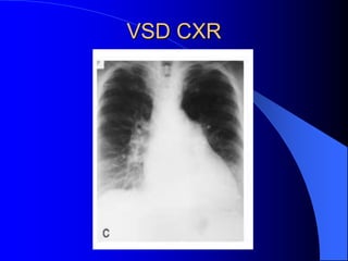 VSD CXR
 