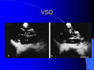 VSD
 