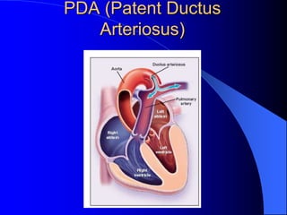 PDA (Patent Ductus
Arteriosus)
 
