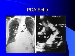PDA Echo
 
