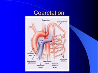 Coarctation
 