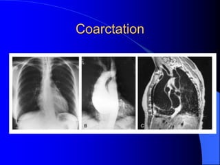 Coarctation
 