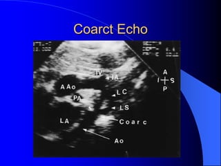 Coarct Echo
 