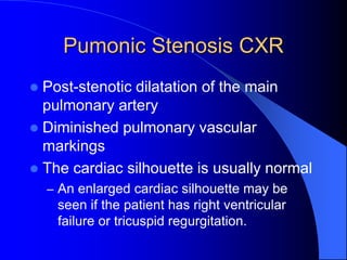 Pumonic Stenosis CXR
 Post-stenotic dilatation of the main
pulmonary artery
 Diminished pulmonary vascular
markings
 The cardiac silhouette is usually normal
– An enlarged cardiac silhouette may be
seen if the patient has right ventricular
failure or tricuspid regurgitation.
 