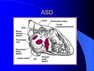 ASD
 