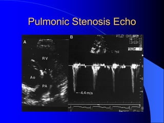 Pulmonic Stenosis Echo
 