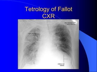 Tetrology of Fallot
CXR
 