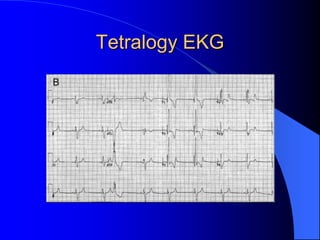 Tetralogy EKG
 