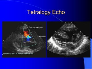 Tetralogy Echo
 