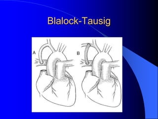 Blalock-Tausig
 