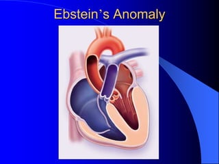 Ebstein’s Anomaly
 