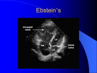 Ebstein’s
 