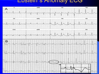 Ebstein’s Anomaly ECG
 