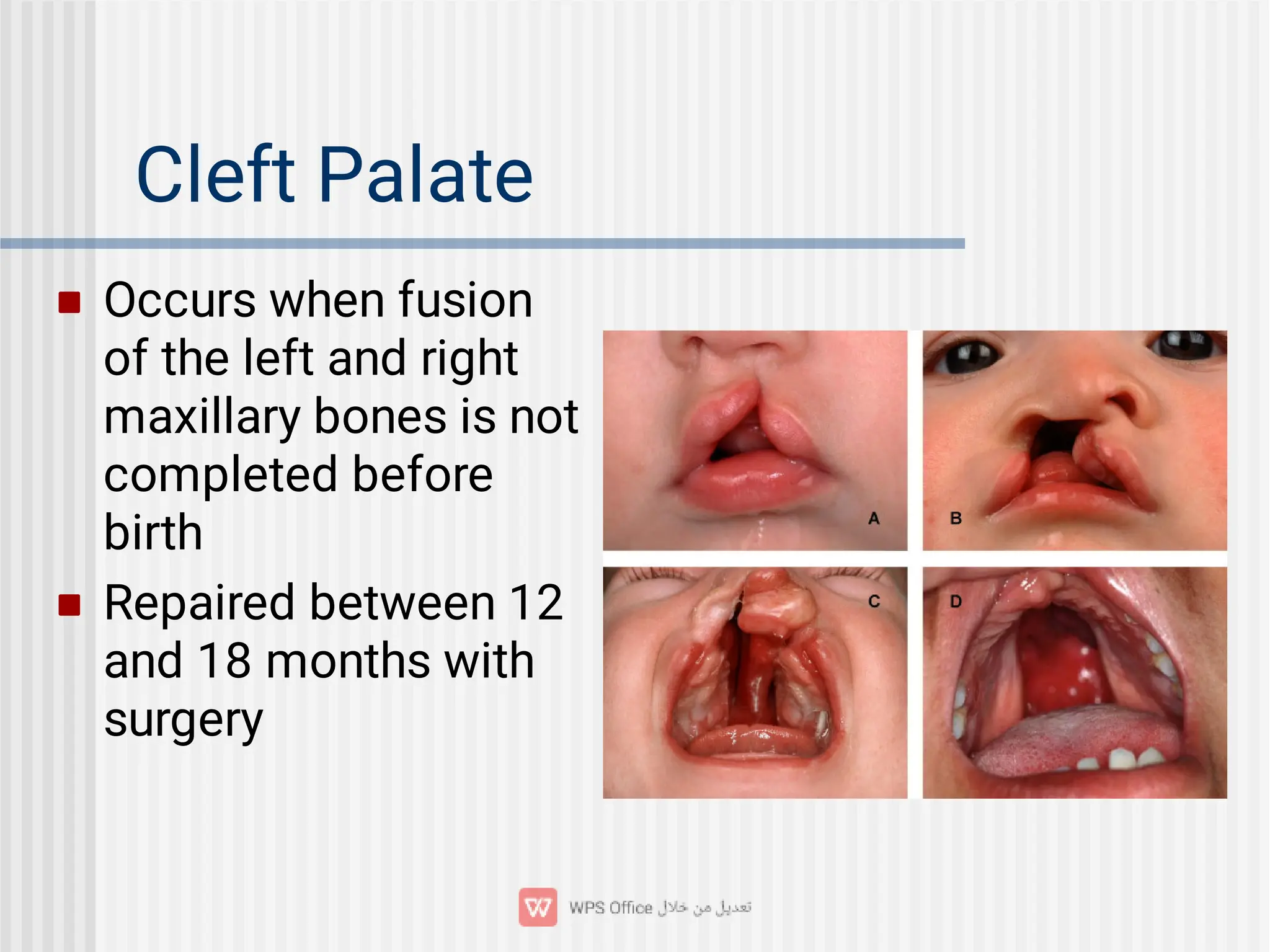 Cleft Palate


Occurs when fusion
of the left and right
maxillary bones is not
completed before
birth
Repaired between 12
and 18 months with
surgery
 