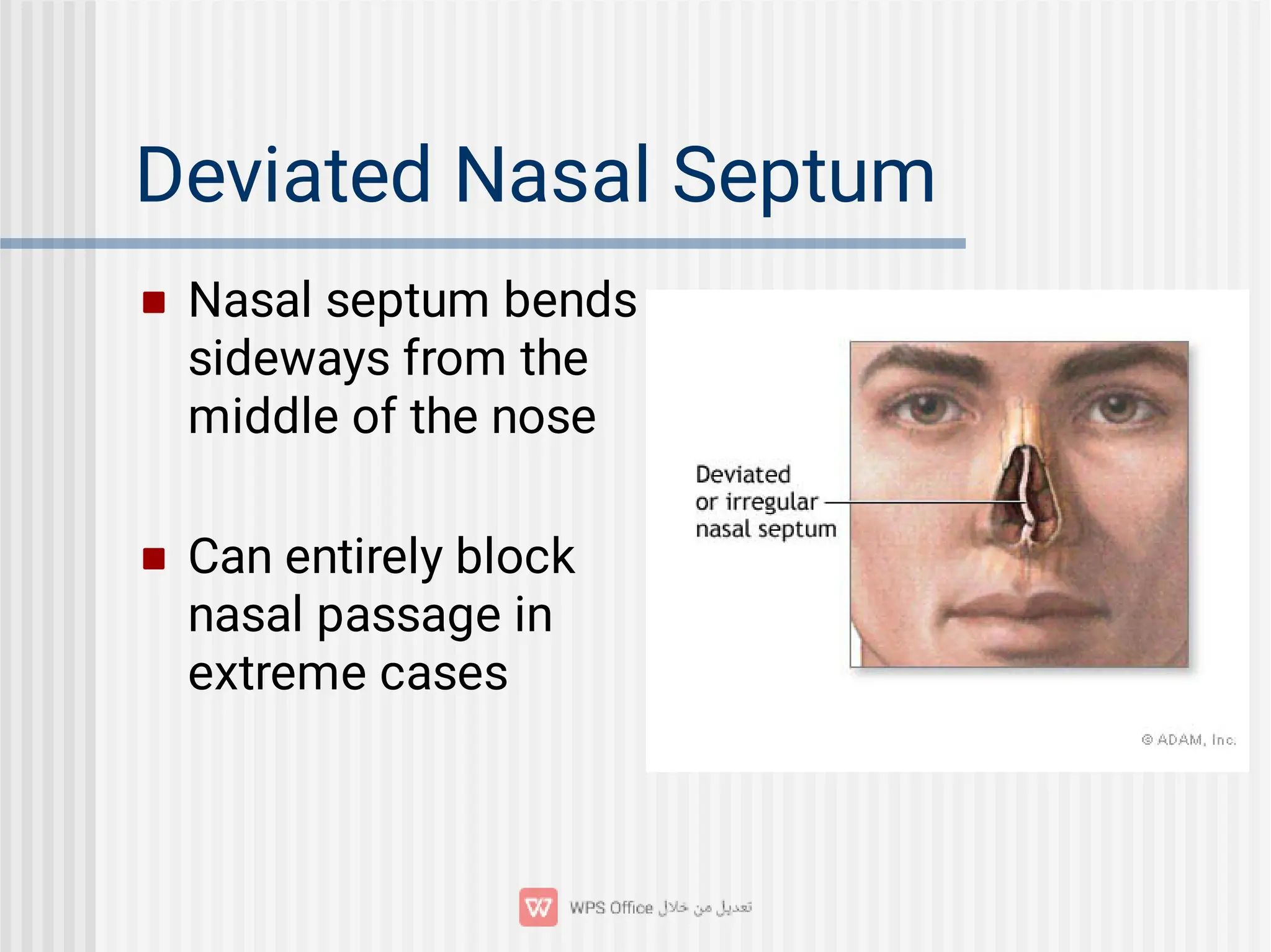 Deviated Nasal Septum


Nasal septum bends
sideways from the
middle of the nose
Can entirely block
nasal passage in
extreme cases
 