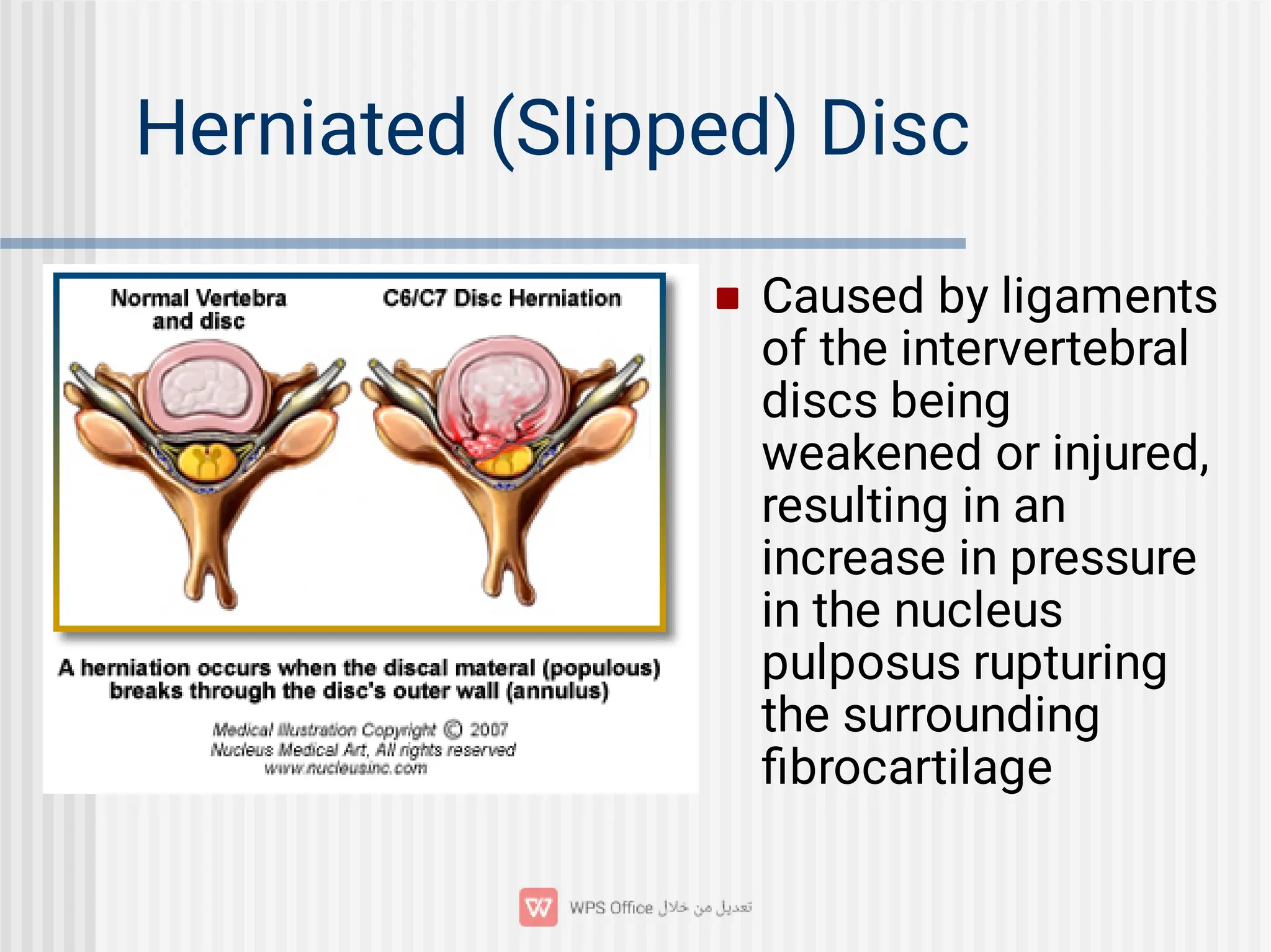 Herniated (Slipped) Disc
 Caused by ligaments
of the intervertebral
discs being
weakened or injured,
resulting in an
increase in pressure
in the nucleus
pulposus rupturing
the surrounding
ﬁbrocartilage
 