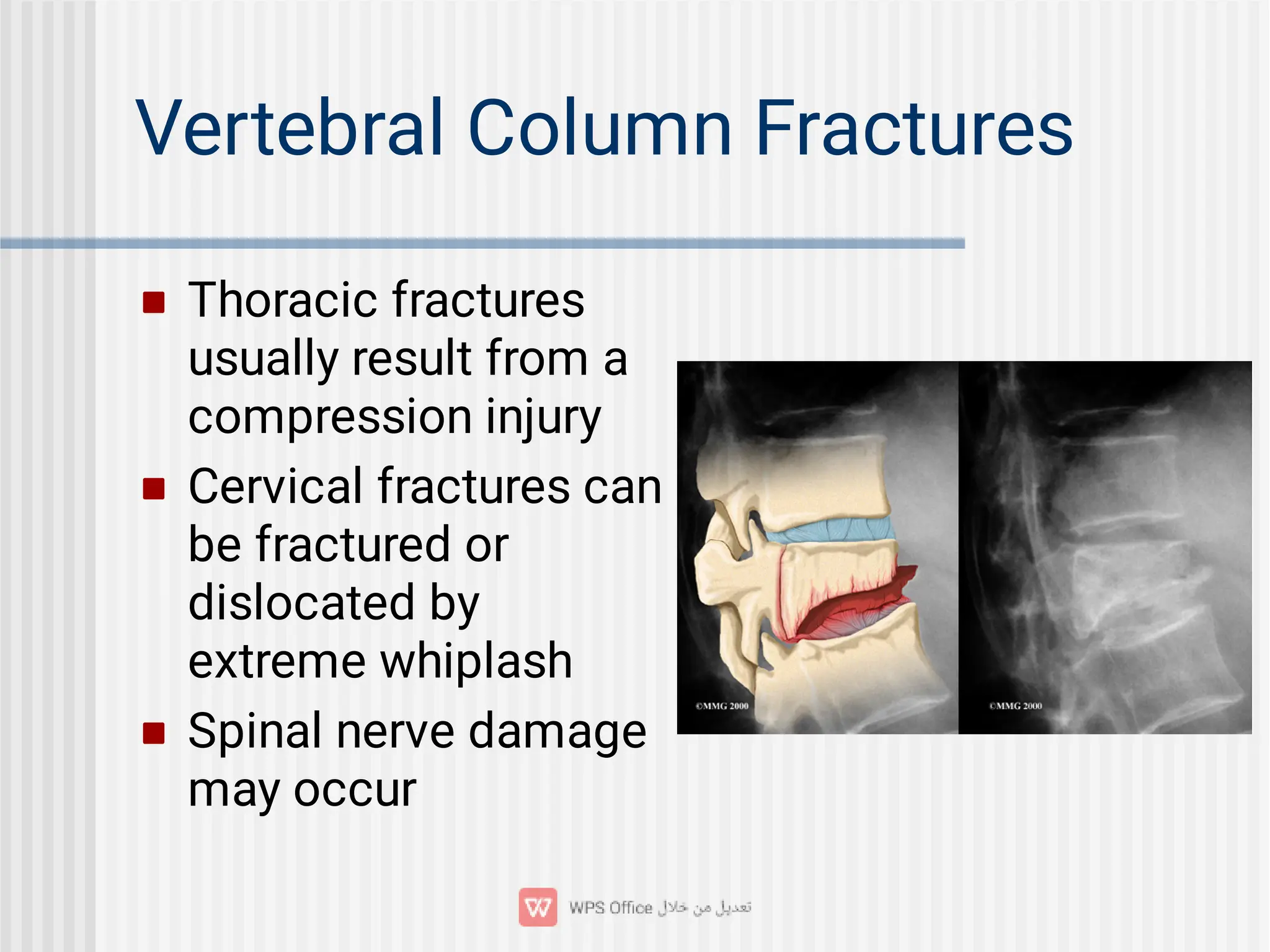 Vertebral Column Fractures



Thoracic fractures
usually result from a
compression injury
Cervical fractures can
be fractured or
dislocated by
extreme whiplash
Spinal nerve damage
may occur
 
