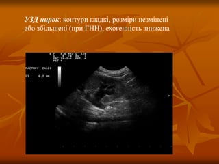 УЗД нирок: контури гладкі, розміри незмінені
або збільшені (при ГНН), ехогенність знижена
 