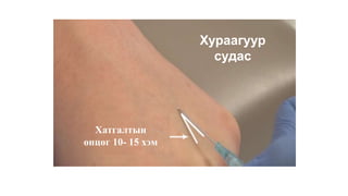 Судас тарилга
Хатгалтын
өнцөг 10- 15 хэм
Хураагуур
судас
 