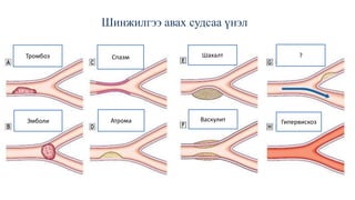 Шинжилгээ авах судсаа үнэл
Тромбоз Шахалт ?
Эмболи Атрома Васкулит Гипервискоз
Спазм
 