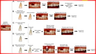Tooth Avulsion Project زيـــاد الــشـرفــي. AVULSION Tooth.pptx