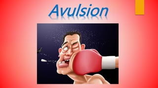 Avulsion
 