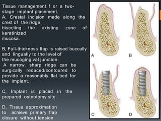 dental implant course for junior dentists.pptx