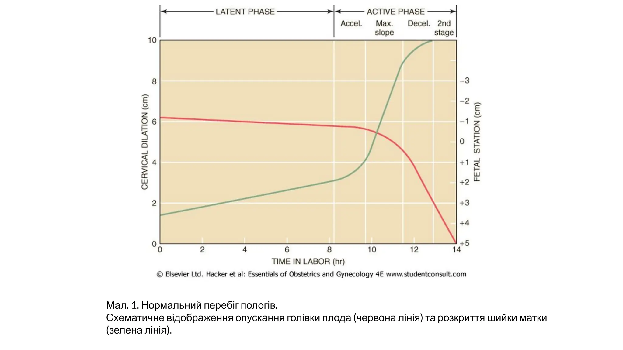 Мал. 1. Нормальний перебіг пологів.
Схематичне відображення опускання голівки плода (червона лінія) та розкриття шийки матки
(зелена лінія).
 