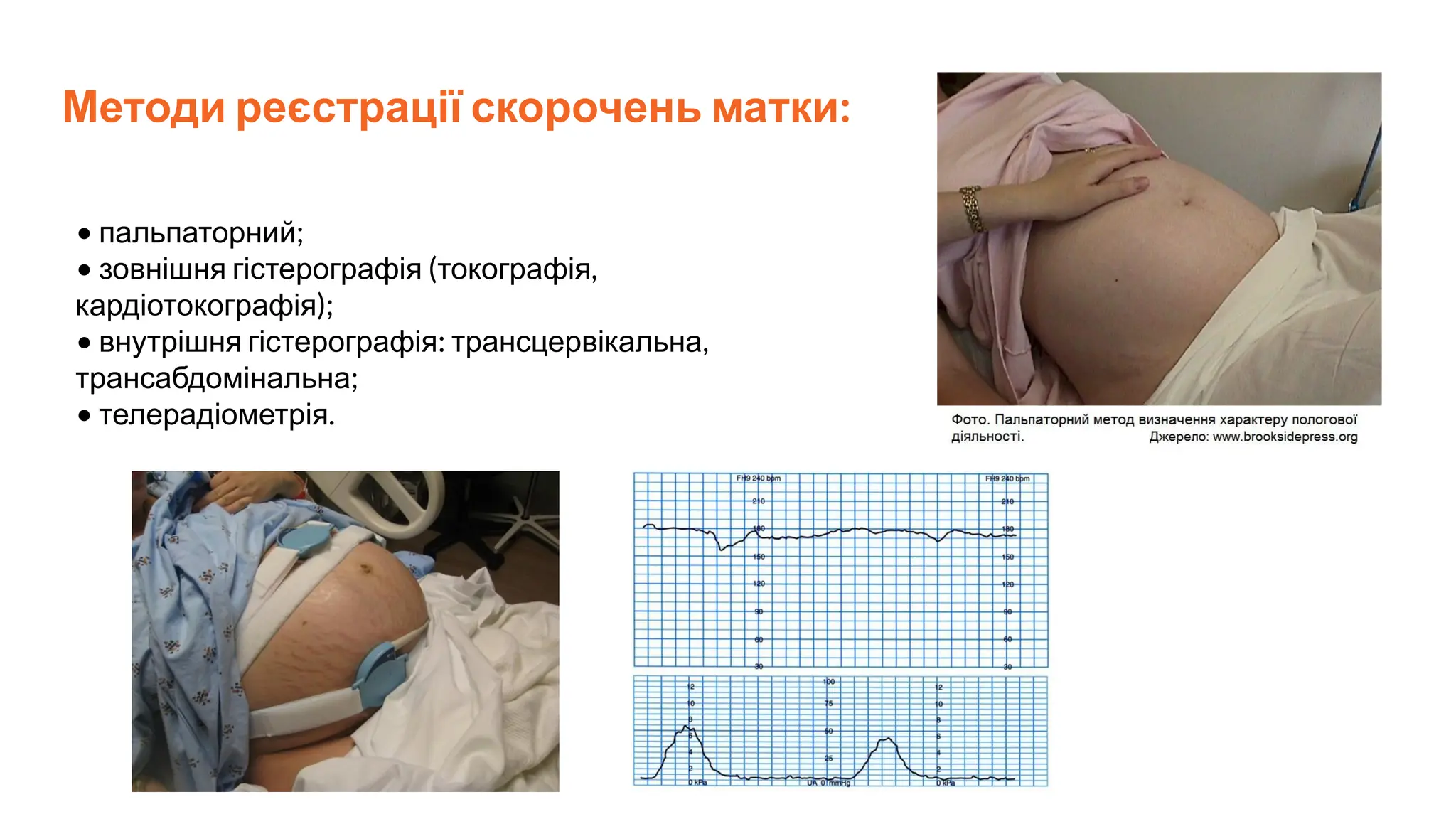 Методи реєстрації скорочень матки:
• пальпаторний;
• зовнішня гістерографія (токографія,
кардіотокографія);
• внутрішня гістерографія: трансцервікальна,
трансабдомінальна;
• телерадіометрія.
 