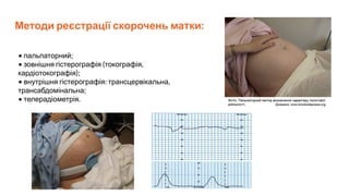 Методи реєстрації скорочень матки:
• пальпаторний;
• зовнішня гістерографія (токографія,
кардіотокографія);
• внутрішня гістерографія: трансцервікальна,
трансабдомінальна;
• телерадіометрія.
 