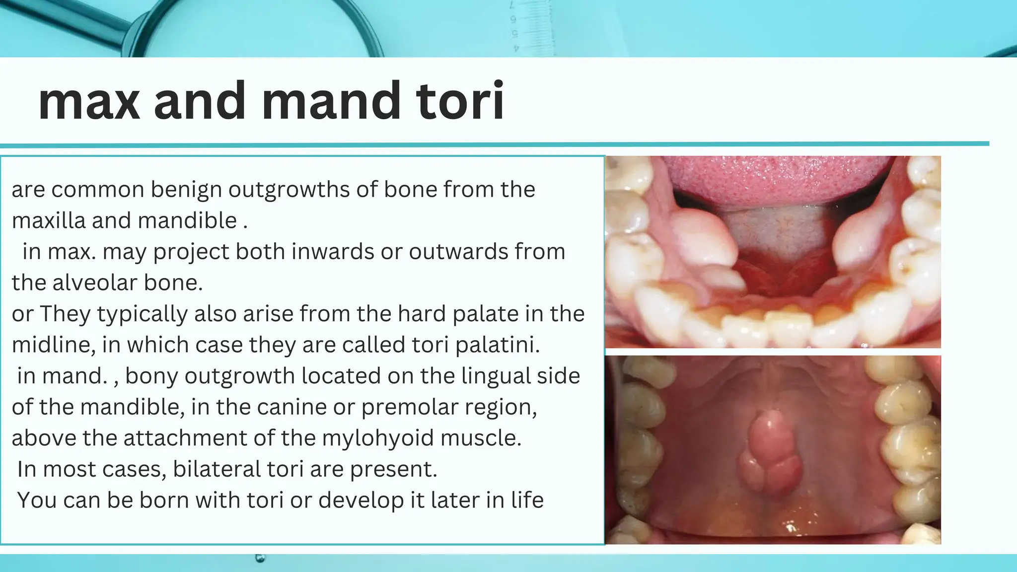 Tori palatinus , tori madibularis and treatment | PPTX | Dental Health