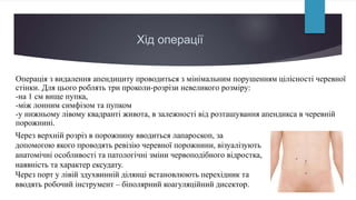 Лапароскопічна апендектомія.pptx........ | PPT