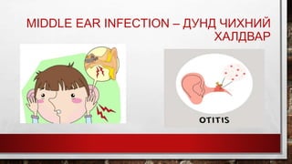 MIDDLE EAR INFECTION – ДУНД ЧИХНИЙ
ХАЛДВАР
 