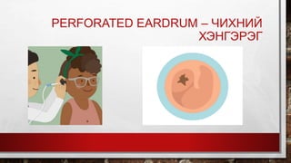 PERFORATED EARDRUM – ЧИХНИЙ
ХЭНГЭРЭГ
 