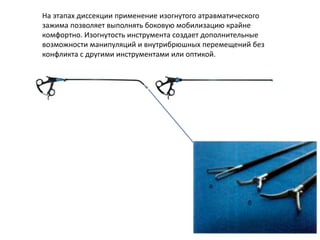 На этапах диссекции применение изогнутого атравматического
зажима позволяет выполнять боковую мобилизацию крайне
комфортно. Изогнутость инструмента создает дополнительные
возможности манипуляций и внутрибрюшных перемещений без
конфликта с другими инструментами или оптикой.
 