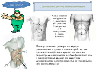 Схема введения
инструментов:
1- лапароскоп
(30 градусов),
2 - ретрактор,
3, 4 -
манипуляторы,
5 - зажим
Babcocok.
Манипуляционные троакары для хирурга
располагаются в правом и левом подреберьях по
среднеключичной линии, троакар для введения
ретрактора устанавливается в субксифоидальной зоне
и дополнительный троакар для ассистента
устанавливается в левом подреберье на уровне пупка
(для зажима Babcock).
 