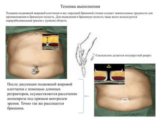 Техника выполнения
Толщина подкожной жировой клетчатки и вес передней брюшной стенки создает значительные трудности для
проникновения в брюшную полость. Для вхождения в брюшную полость чаще всего используется
параумбиликальная (рядом с пупком) область.
Скальпелем делается полукруглый разрез
После диссекции подкожной жировой
клетчатки с помощью длинных
ретракторов, осуществляется рассечение
апоневроза под прямым контролем
зрения. Точно так же рассекается
брюшина.
 