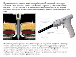 После создания доступа вводится специальный троакар обтурируюший отверстие во
избежание утечки вводимого в живот газа. Давление углекислого газа в животе обычно
составляет 14мм рт.ст., однако из-за значительного веса брюшной стенки для создания
адекватной экспозиции места операции давление приходится увеличивать давление до 16мм
рт.ст.
Проводится ревизия брюшной полости и под прямым визуальным контролем в брюшную
полость вводятся остальные четыре трокары. Хирург манипулирует в ходе операции
инструментами в субксифоидальном и левым среднеключичном трокарах (нами успешно
применяется изогнутый атравматический зажим Буэсса). Иногда возникает
необходимость смены 5 мм. трокаров на 10 мм., что дает возможность свободно менять
положение инструментов по мере необходимости.
 