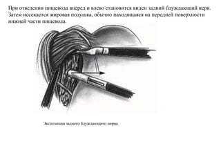 При отведении пищевода вперед и влево становится виден задний блуждающий нерв.
Затем иссекается жировая подушка, обычно находящаяся на передней поверхности
нижней части пищевода.
Экспозиция заднего блуждающего нерва.
 