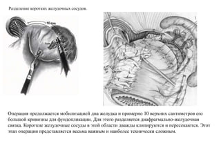 Операция продолжается мобилизацией дна желудка и примерно 10 верхних сантиметров его
большой кривизны для фундопликации. Для этого разделяется диафрагмально-желудочная
связка. Короткие желудочные сосуды в этой области дважды клипируются и пересекаются. Этот
этап операции представляется весьма важным и наиболее технически сложным.
Разделение коротких желудочных сосудов.
 