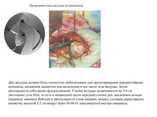 Дно желудка должно быть полностью мобилизовано для предотвращения перекручивания
пищевода, натяжения манжетки или включения в нее части тела желудка. Затем
производится собственно фундопликация. Стенка желудка захватывается на 5-6 см
дистальнее угла Hiss, то есть в наивысшей части передней стенки дна, введенным позади
пищевода зажимом Babcock и протягивается слева направо, вперед, создавая циркулярную
манжетку высотой 2-3 см вокруг бужа 56-60 Fr, находящегося внутри пищевода.
Проведение свода желудка за пищеводом.
 