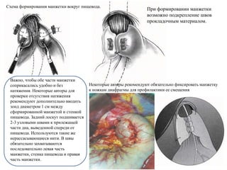 При формировании манжетки
возможно подкрепление швов
прокладочным материалом.
Схема формирования манжетки вокруг пищевода.
Некоторые авторы рекомендуют обязательно фиксировать манжетку
к ножкам диафрагмы для профилактики ее смещения
Важно, чтобы обе части манжетки
соприкасались удобно и без
натяжения. Некоторые авторы для
проверки отсутствия натяжения
рекомендуют дополнительно вводить
зонд диаметром 1 см между
сформированной манжетой и стенкой
пищевода. Задний лоскут подшивается
2-3 узловыми швами к прилежащей
части дна, выведенной спереди от
пищевода. Используются такие же
нерассасывающиеся нити. В швы
обязательно захватываются
последовательно левая часть
манжетки, стенка пищевода и правая
часть манжетки.
 