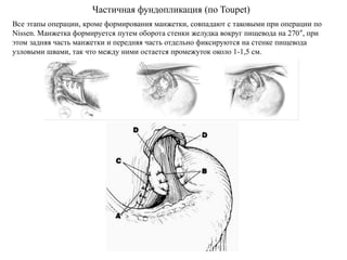 Частичная фундопликация (по Toupet)
Все этапы операции, кроме формирования манжетки, совпадают с таковыми при операции по
Nissen. Манжетка формируется путем оборота стенки желудка вокруг пищевода на 270°, при
этом задняя часть манжетки и передняя часть отдельно фиксируются на стенке пищевода
узловыми швами, так что между ними остается промежуток около 1-1,5 см.
 