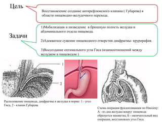 Восстановление создание антирефлюксного клапана ( Губарева) в
области пищеводно-желудочного перехода.
Цель
1)Мобилизация и низведение в брюшную полость желудка и
абдоминального отдела пищевода.
2)Адекватное сужение пищеводного отверстия диафрагмы- крурорафия.
3)Воссоздание оптимального угла Гиса (взаимоотношений между
желудком и пищеводом )
Задачи
Расположение пищевода, диафрагмы и желудка в норме: 1 - угол
Гиса, 2 - клапан Губарева
Схема операции фундопликации по Ниссену:
А - из дна желудка вокруг пищевода
образуется манжетка; Б - окончательный вид
операции, восстановлен угол Гиса.
 