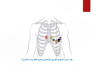 10
-
‫الصدرية‬ ‫لالكترودات‬ ‫لوضع‬ ‫الموضعي‬ ‫التوزيع‬ ‫توضح‬ ‫صورة‬
 